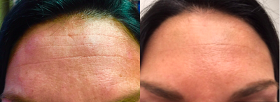 Botox before and after photo