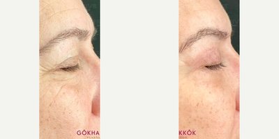 Eyelid Surgery before and after photo