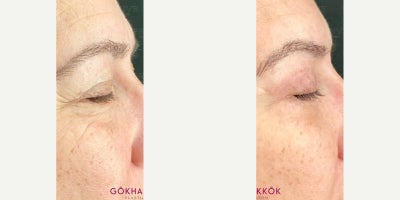 Eyelid Surgery before and after photo