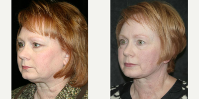 Facelift before and after photo