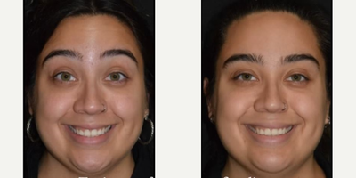 FaceTite before and after photo
