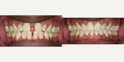 Invisalign before and after photo