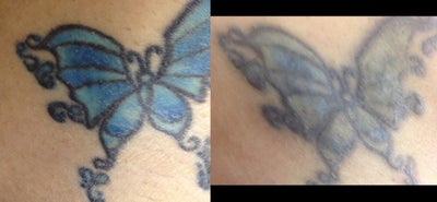 PicoSure before and after photo
