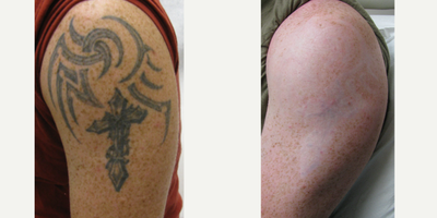 PicoSure before and after photo