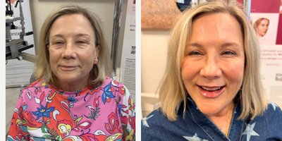 Skin Rejuvenation before and after photo