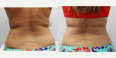 Smart Lipo before and after photo