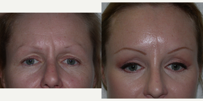 Brow Lift before and after photo