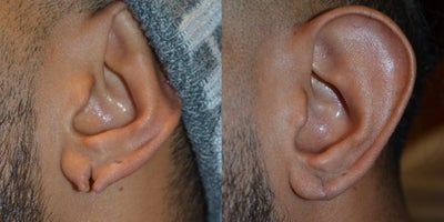 Earlobe Repair before and after photo