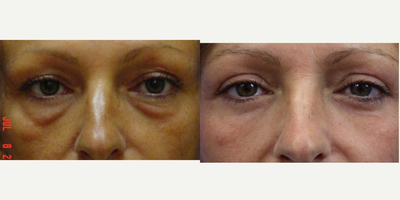 Eyelid Surgery before and after photo