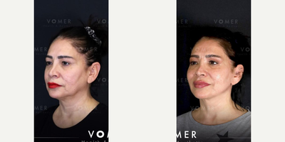 Facelift before and after photo