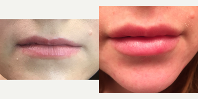Lip Fillers before and after photo