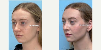 Morpheus8 before and after photo