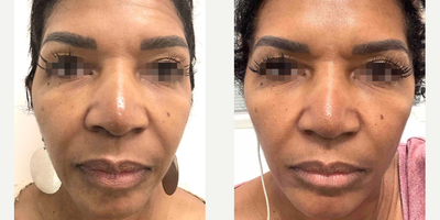 Dermal Fillers before and after photo