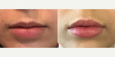 Juvederm before and after photo