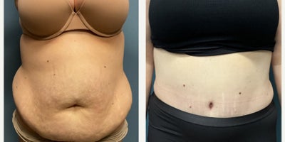 Liposuction before and after photo