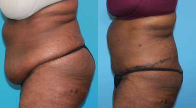 Tummy Tuck before and after photo