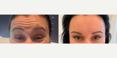 Botox before and after photo