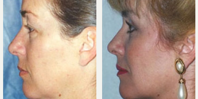 Eyelid Surgery before and after photo
