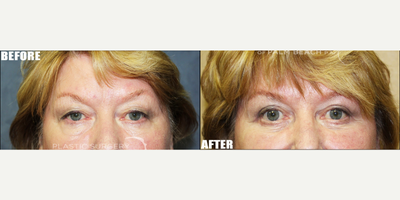 Eyelid Surgery before and after photo