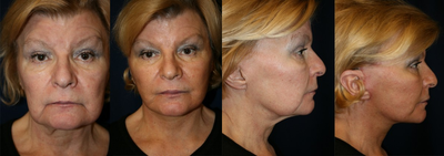 Facelift before and after photo