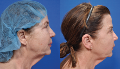 Facelift before and after photo
