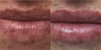 Juvederm before and after photo