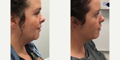Kybella before and after photo