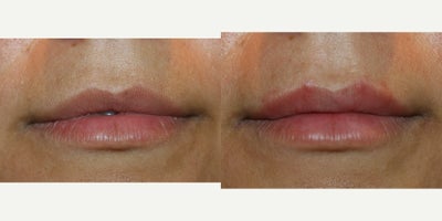 Lip Fillers before and after photo