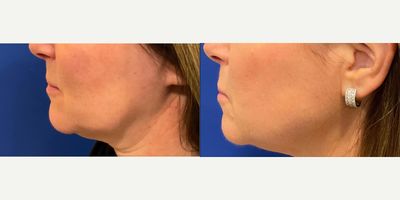 Lip Fillers before and after photo