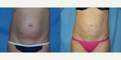 Liposuction before and after photo