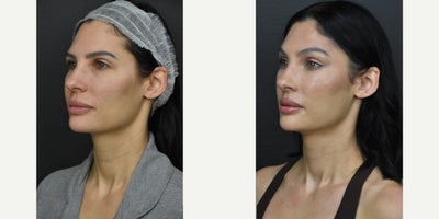 Facial Fat Transfer before and after photo