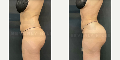 Lipo 360 before and after photo