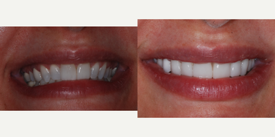 Porcelain Veneers before and after photo
