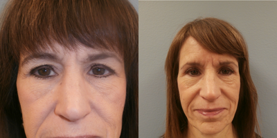 Eyelid Surgery before and after photo