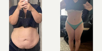 Lipo 360 before and after photo
