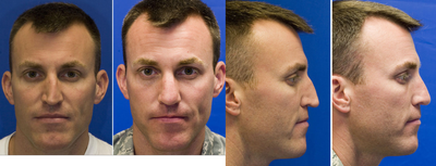 Revision Rhinoplasty before and after photo