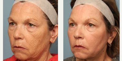 ActiveFX before and after photo