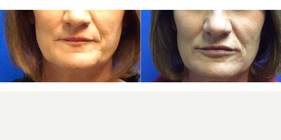 Juvederm before and after photo