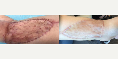 Laser Resurfacing before and after photo