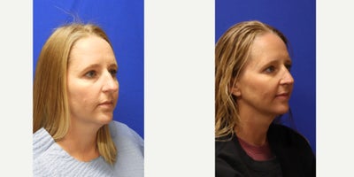 Rhinoplasty before and after photo