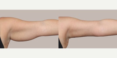 Arm Lift before and after photo