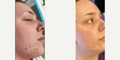 Chemical Peel before and after photo