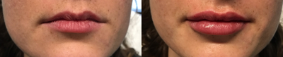 Juvederm before and after photo
