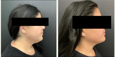 Kybella before and after photo