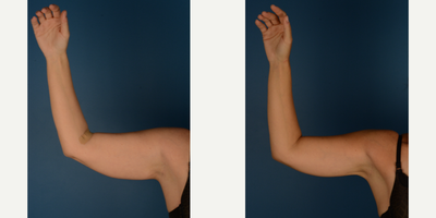 Liposculpture before and after photo