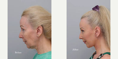Neck Lift before and after photo