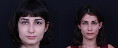 Rhinoplasty before and after photo