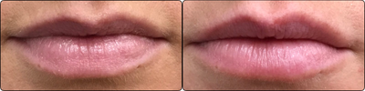 Dermal Fillers before and after photo