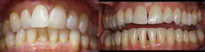 Invisalign before and after photo