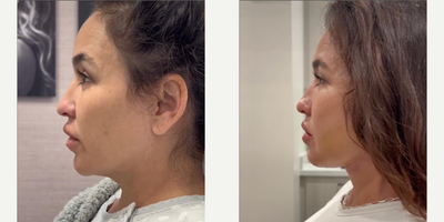 Neck Lift before and after photo